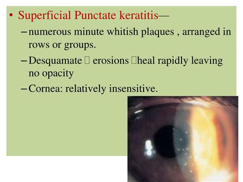 Ppt Fungal Keratitis Powerpoint Presentation Free Download Id8876972