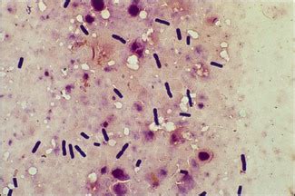 Clostridium Perfringens Gram Stain