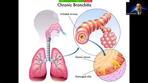 Management Of Lower Respiratory Tract Infections Youtube