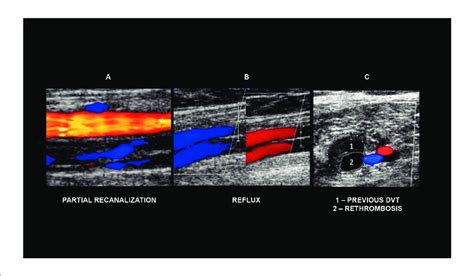 -Ultrasound changes that may be found in the follow-up of patients with ...