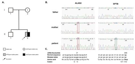 Jcm Free Full Text Severe Microcytic Anemia Caused By Complex Hereditary Spherocytosis And X