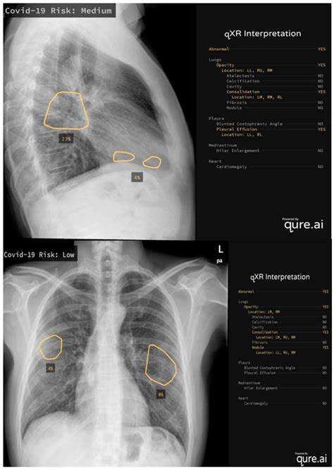 Chest X Ray Pleural Effusion