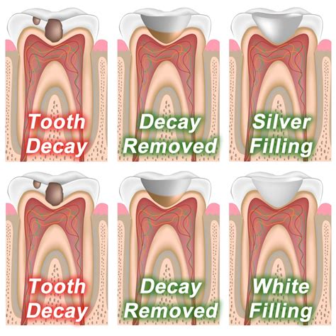 White Dental Fillings Spring TX | Spring Complete Care Dentistry