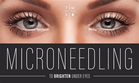 Microneedling Under Eye Treatment — The Med Spa