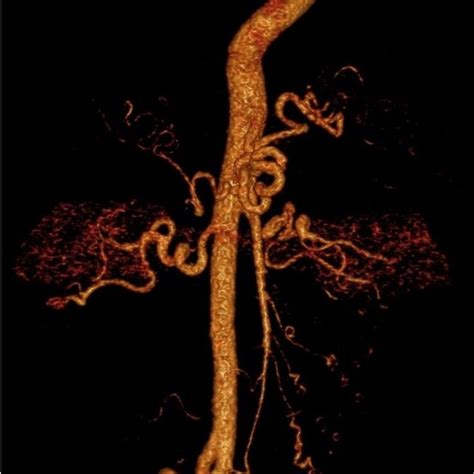 Three Dimension Reconstruction Of Angio Ct Scan Of The Thoracic And