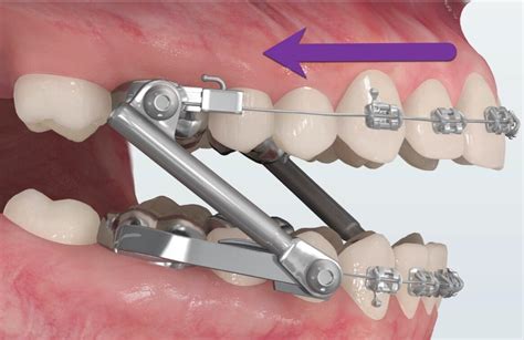 Does Orthodontic Treatment Cause Sleep Apnea Jorgensen Orthodontics