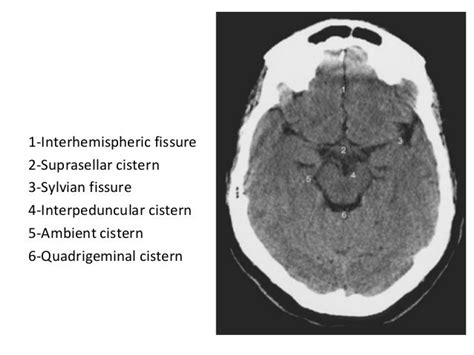 Basal Cistern Subarachnoid Hemorrhage