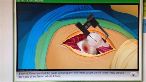 THE DOCTOR IS IN | Virtual Hip Resurfacing Surgery. EdHeads - YouTube