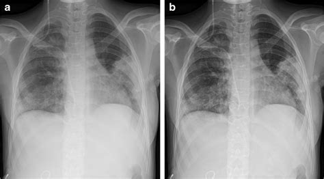 An Anteroposterior Chest Radiograph Kv Mas Cgycm