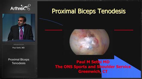 Arthrex Proximal Biceps Tenodesis