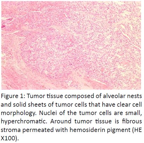 Tumor Tissue Composed Of Alveolar Nests And Solid Sheets Of Tumor Cells