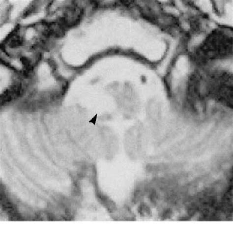 Axial T 2 Weighted Magnetic Resonance Image Performed On March 29 Day