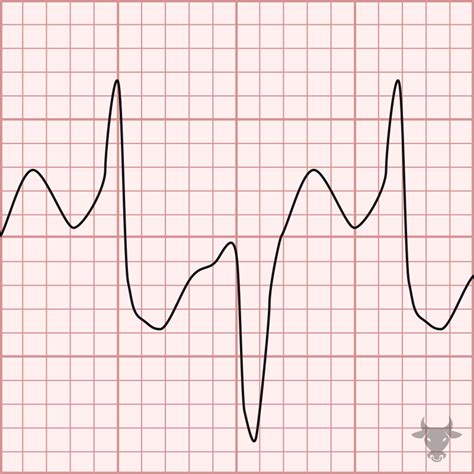 Polymorphic Ventricular Tachycardia | ECG Stampede