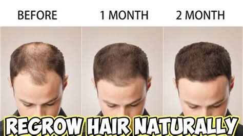 Regrow Hair Naturally For Men Hairfall Natural Solution Prevent Baldness How To Stop