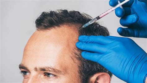 Treatments For Hair Loss South Jersey Hair Treatments