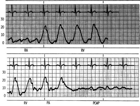 Normal pressures and waveforms obtained as the PA catheter is advanced... | Download Scientific ...