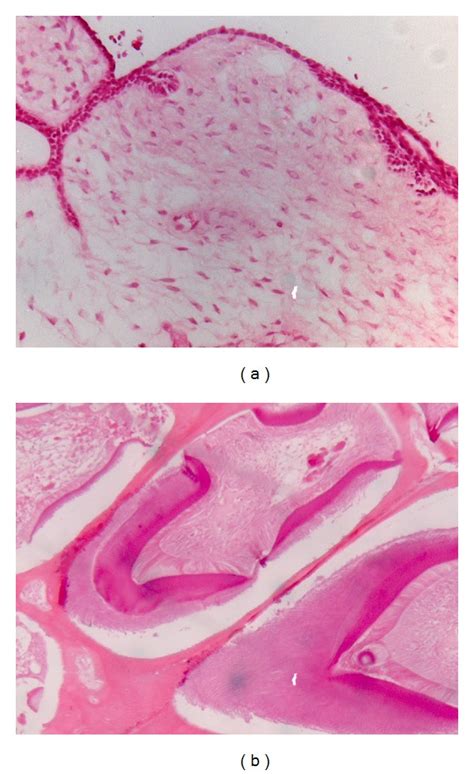 Low Magnification Photomicrograph Demonstrates That The Lesion Was