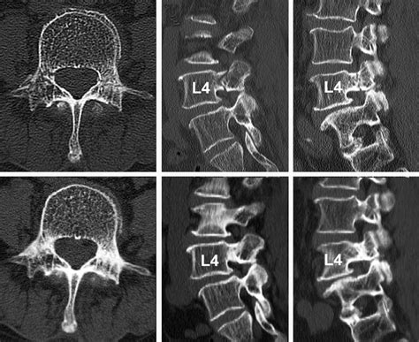 Pedicle Fracture