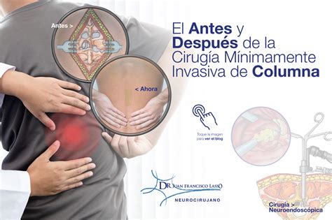 El antes y después de la cirugía mínimamente invasiva de columna Dr