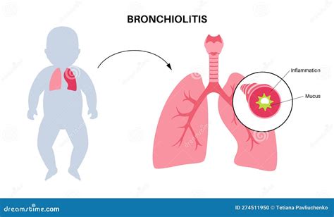 Bronchiolitis Lung Disease Vector Illustration Cartoondealer