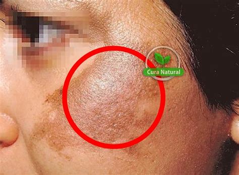 Melasma Como Tratar Em Casa Passo A Passo Receitas E Dicas Cura