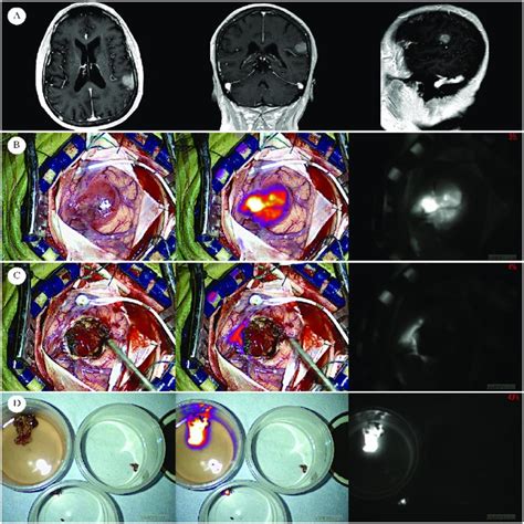 Human Left Parietal Lobe Glioblastoma Row A Preoperative Mri Of Newly