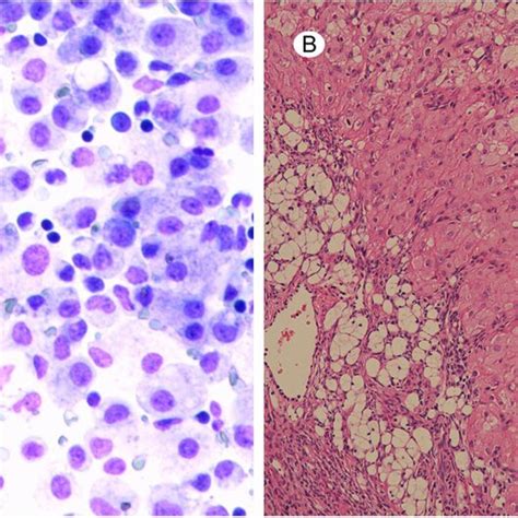 Results Of Ascitic Fluid Cytology And Histopathological Tests A Download Scientific Diagram