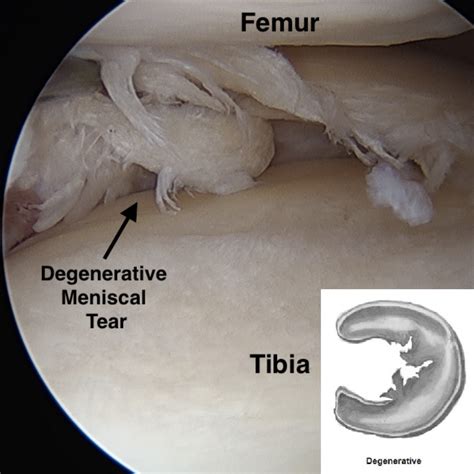 Degenerative Meniscus Tear - Carolinas Pain Center - Chronic Conditions
