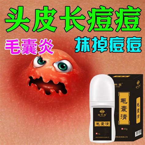 Pustules pimple scalp folliculitis head acne bacteriostatic itching itchy rash cream body ...