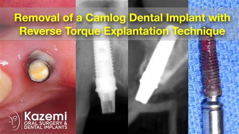 Removal Of A Camlog Dental Implant With Reverse Torque Explantation