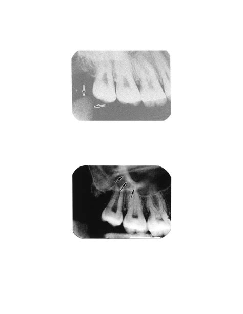 Coronoid Process Of Mandible