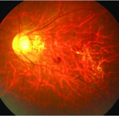 (PDF) Recurrent subretinal haemorrhages and progressive lacquer cracks in a high myope