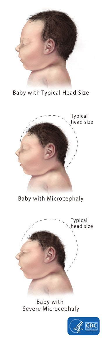 Microcephaly