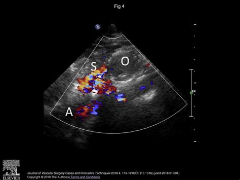 Aberrant Splenic Artery Complicated By Aneurysm During Pregnancy Ppt Download