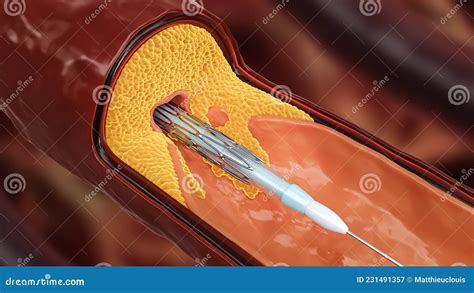 Illustration De Rendu 3d De L Angioplastie Livraison De Stents Avec