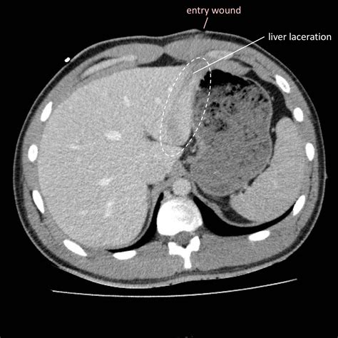 Abdominal Trauma And Other Pathology Radiology Cafe