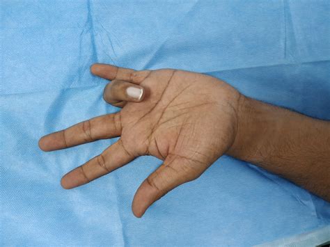 Ring Finger In Locked Position Shri Bone And Joint Clinic