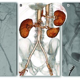 Total Aortobifemoral Abf Bypass Recanalization Images At Final