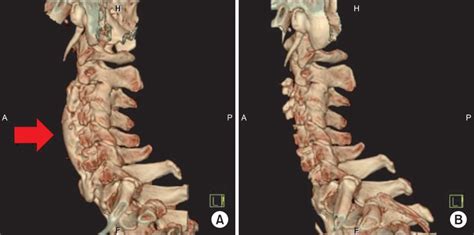 Three Dimensional Reconstruction Computed Tomography Of Cervical Spine