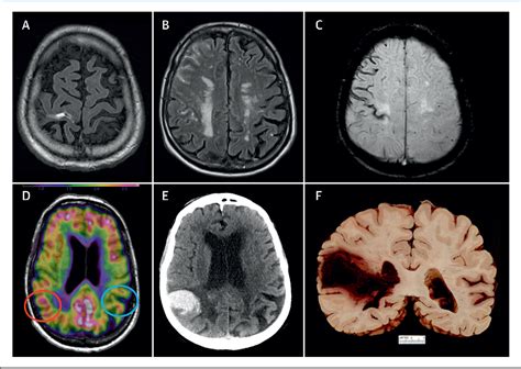 Figure 4 from Cerebral Amyloid Angiopathy: Diagnosis, Clinical ...