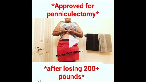 Panniculectomy Covered By Kaiser Insurance Life Insurance Quotes