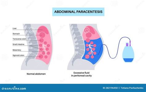 Paracentesis Cartoons Illustrations And Vector Stock Images 23