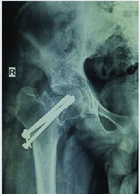 One Month Follow Up Radiograph Figure 6 Six Months Follow Up