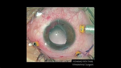 Traumatic Cataract Vh And Mydriasis Yamani Technique For Only One Haptic Ppl Ppv Youtube