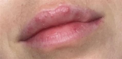 TINY BUMPS ON LIPS : r/SkincareAddicts