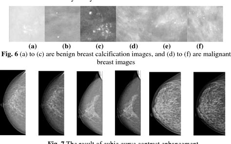 Figure 6 from The Classification of Breast Calcification using Texture Feature of Fractal-based ...