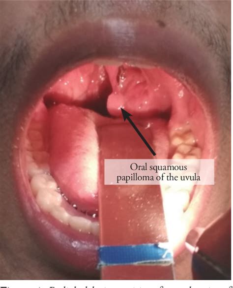 Figure 1 From Symptomatic Oral Squamous Papilloma Of The Uvula A Rare Incidental Finding