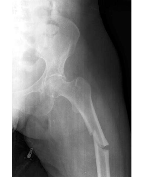 Femur Bone Fracture