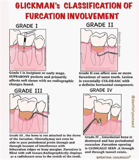 Grades Of Furcation Medizzy