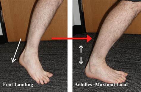 Understanding Achilles Tendon Ruptures Footeducation